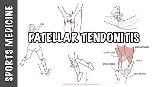 Patellar Tendonitis and Patellar Tendinopathy by Armando Hasudungan 7,700 views 5 months ago 7 minutes, 53 seconds