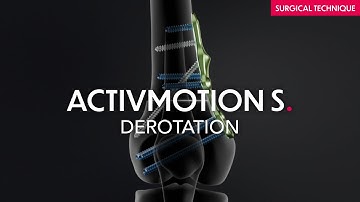 Surgical technique - DFO - Derotation and closing Plate - Activmotion S