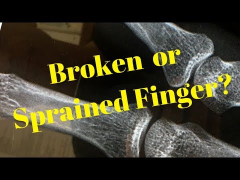 Video: Sprained Finger: Symtom, Hembehandlingar Och Mer