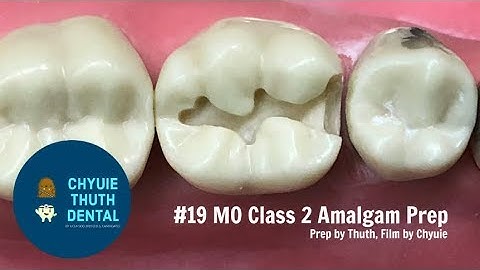 [ChyuieThuth] #19 MO Class 2 Amalgam Prep