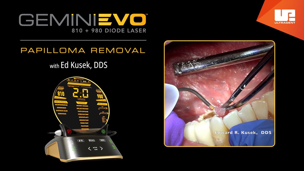 Papilloma Removal Gemini™ EVO clinical cases YouTube