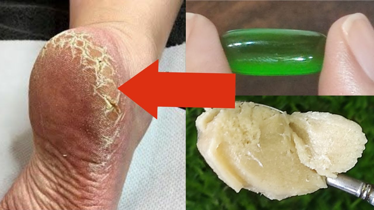 Cracked Heels Home Remedy: This DIY Home Remedy for Cracked Heels Works  Like a Charm! | - Times of India