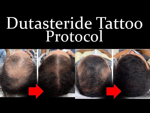 Dutasteride Tattoo Protocol: