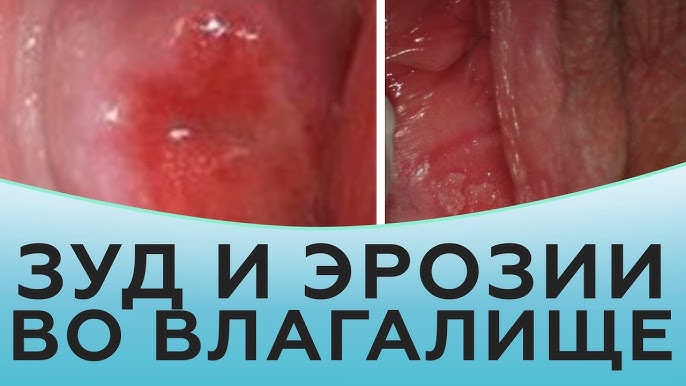 Снижение чувствительности влагалища Снижение чувствительности влагалища