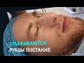 Мужчины тоже делают ЭТО! Лазерное омоложение лица