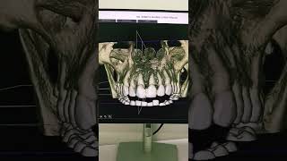 UPPER JAW CBCT CYST IN FRONT 1STQ, #abdomen #religion #ctscan #siemens #medical #dentalscan #anatomy