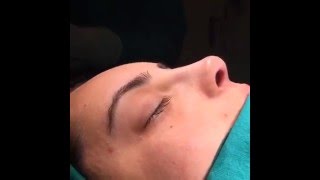 Rhinoplasty - Before After - Assoc.prof.dr. Suleyman Tas