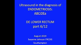 612 Abcdendometriosis - Retrocervical Nodules Die Involving Posterior L Fornixlower
