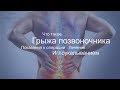 Что такое грыжа позвоночника | Лечение иглоукалыванием