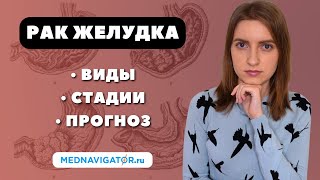 РАК ЖЕЛУДКА - виды, стадии, прогноз | Сколько живут с ОПУХОЛЬЮ ЖЕЛУДКА? #меднавигатор