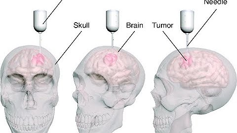 Biopsy CPT codes - simplify medical coding