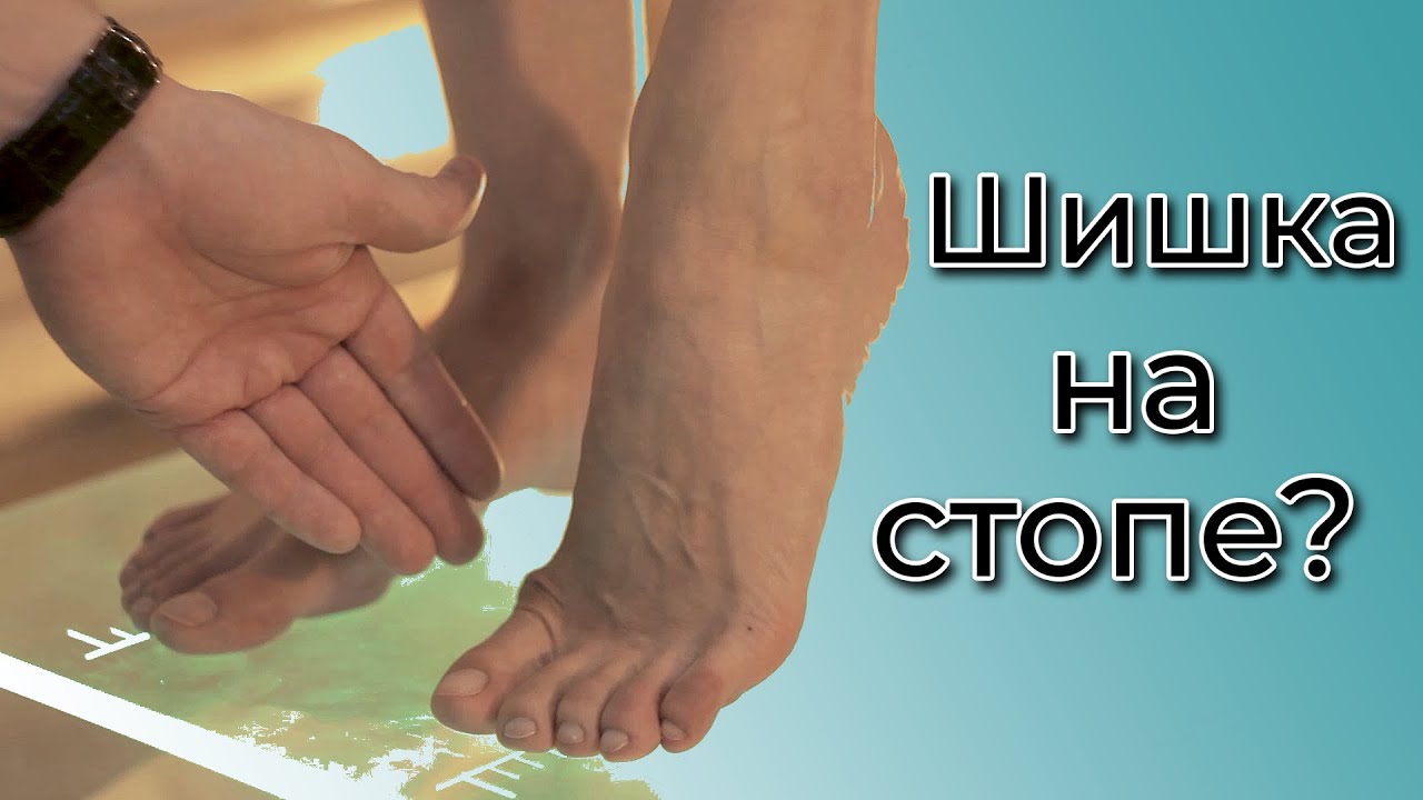 4 причины деформации стопы