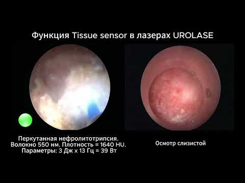 Функция "Детектор ткани" в лазерах линейки UROLASE