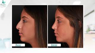 İzsiz Burun Estetiği (Rhinoplasty) Nasıl Yapılır? Flora Klinik 2019