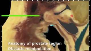 Guiding Medical Needles Using Tissue Manipulation