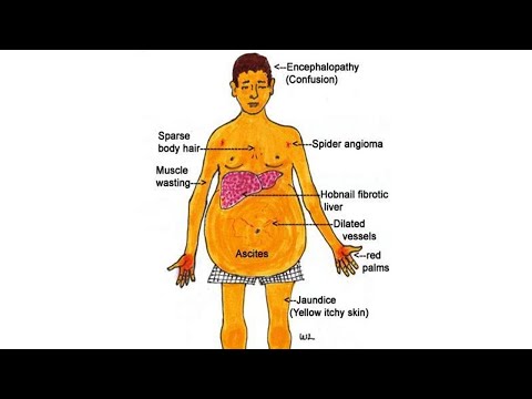 02-20 Циррозы печени