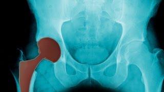 Learn about the Northwest Region's Center for Hip and Knee Replacement, and Robotic Surgery