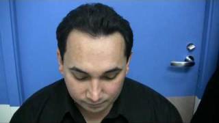 Hair Transplant in 2011 by Dr. Wong