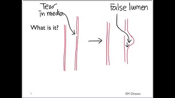 Aortic Dissection - Part 1