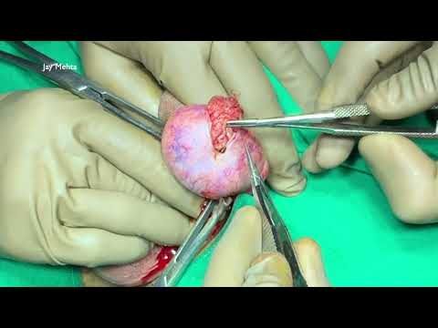 microTESE for Non Obstructive Azoospermia (NOA)