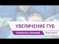 Контурная пластика губ - увеличение губ гиалуроновой кислотой