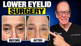 Lower Eyelid Surgery: What You Need to Know Before Surgery