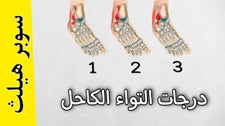 درجات التواء الكاحل وكم تستغرق مدة العلاج |سوبر هيلث (2)