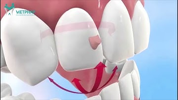 Video mô phỏng quy trình niềng răng không mắc cài Invisalign