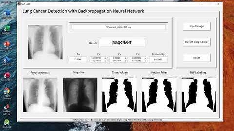 Lung Cancer Detection with Backpropagation Neural Network using Matlab
