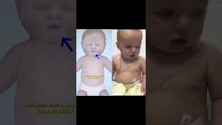 Sinais De Bronquiolite Em Bebês