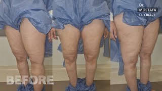 Thigh Lift With Dr. Mostafa ElOkazi | قبل وبعد عملية شد ترهلات الفخذين