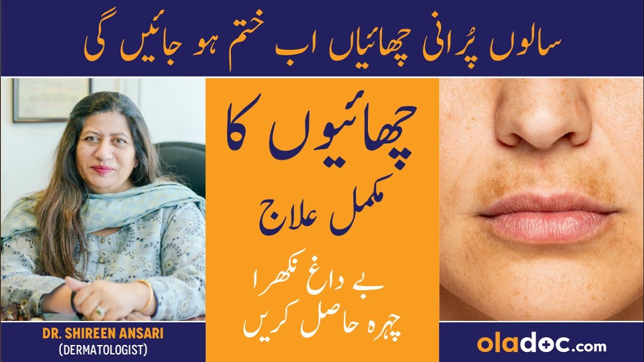 GET RID OF PIGMENTATION   Chaiyan Khatam Karne Ka Tarika   Melasma Aur Pigmentation Ka Ilaj