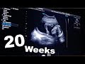 💖20 WEEKS Pregnant Ultrasound - BABY SUCKING HIS THUMB💖