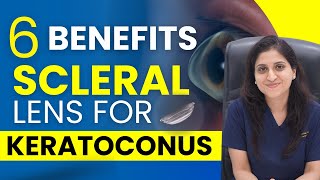 Information Top 6 Benefits of Scleral Lenses for Keratoconus Update