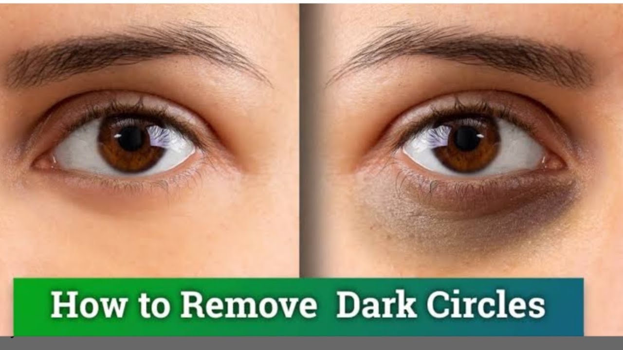 How to remove Dark Circles | डार्क सर्कल्स के लिए पैक - YouTube