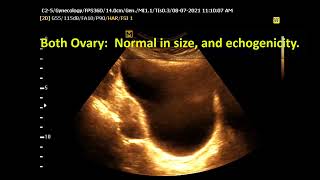 Ultrasound cases 91 of 2000 || Prolonged menstruation