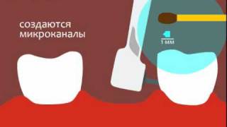 протезирование cbw