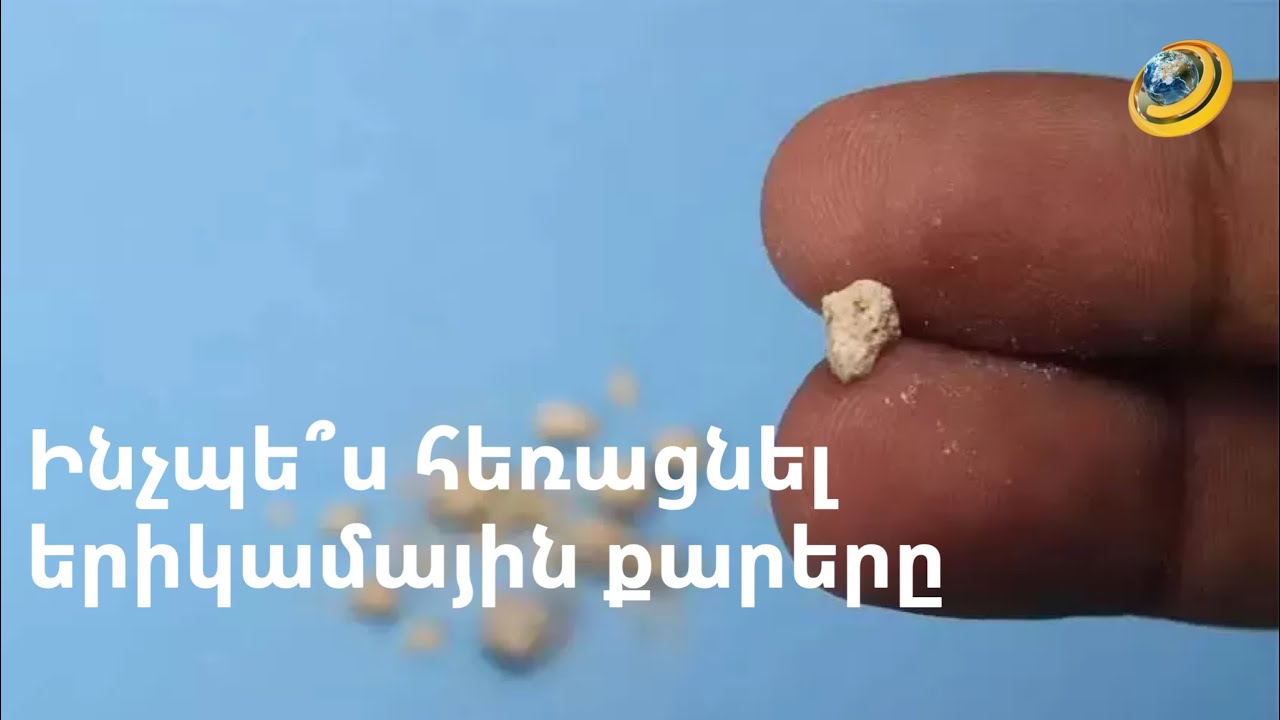 Երիկամային քարերի անցավ հեռացման նոր մեթոդներ