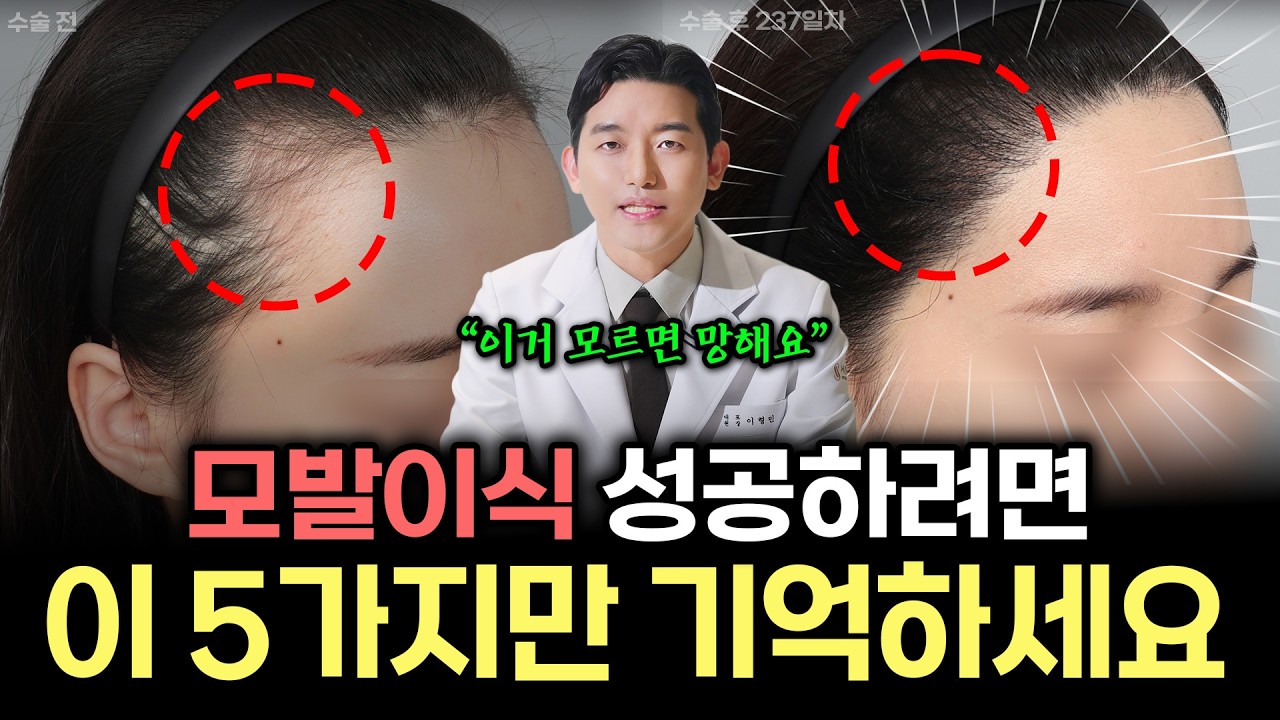 ‘모발이식 무조건 성공하는 5가지 방법’│의사로서 솔직하게 말씀드리겠습니다.