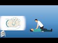 إسعافات أولية إنعاش قلبي رئوي 
