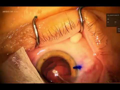 Vidéo : la chirurgie de la cataracte filmée au bloc opératoire