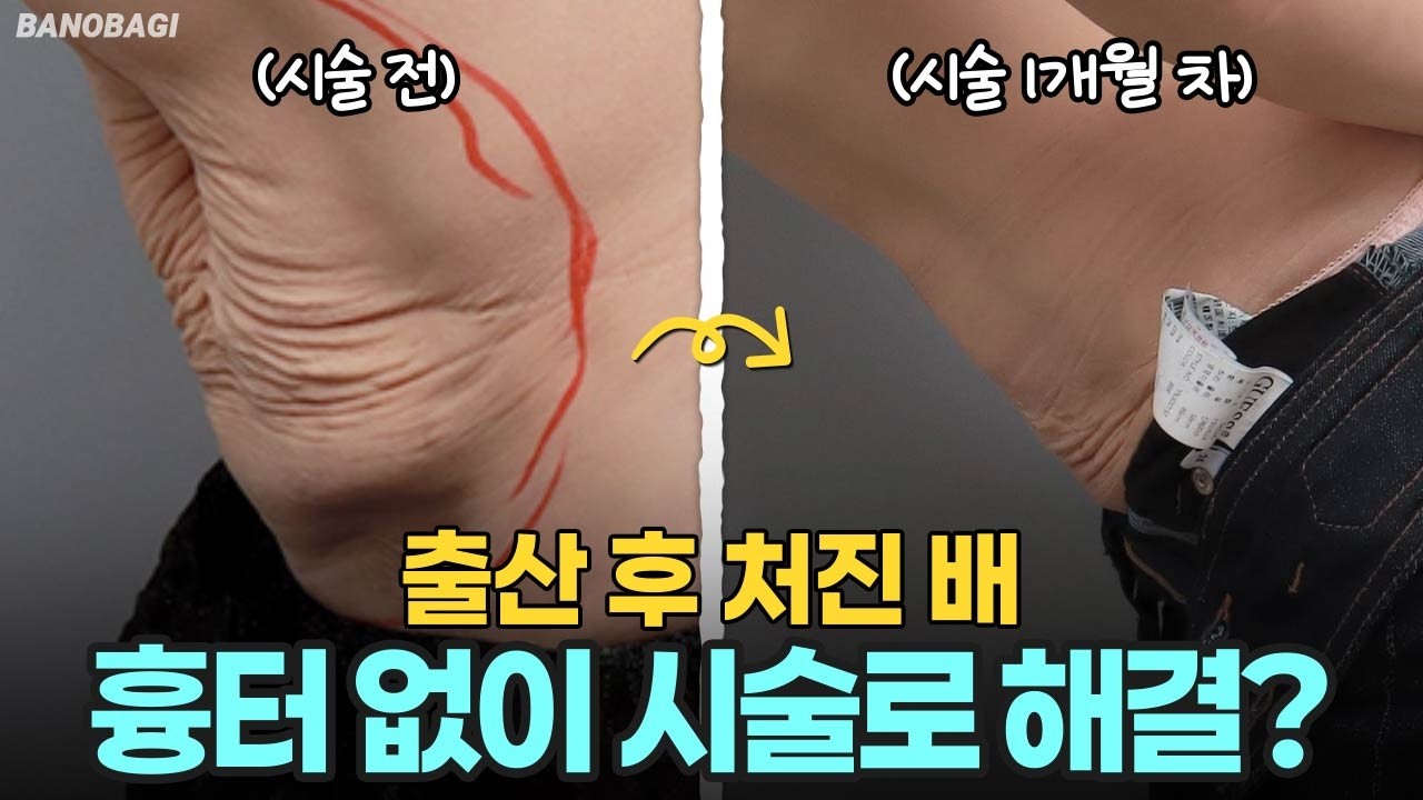 출산, 다이어트 후 처진 뱃살! 무작정 지흡하면 안 되는 이유😱 수술 없이 탄력 끌어올리는 법🔥