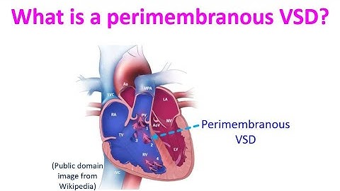 What is a perimembranous VSD?