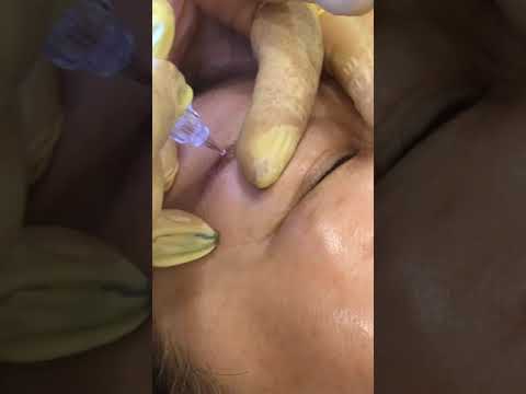 New 반영구 색소제거액(이레이저)사용법