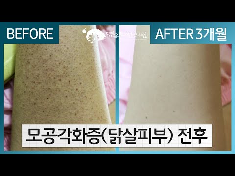 강남 모공강화증치료 닭살피부 화안케어 후기 7
