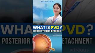 What is Posterior Vitreous Detachment (PVD) ? || Eye Floaters Explained