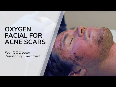 Oxygen Facial For Acne Scars Post-CO Laser Resurfacing Treatment  | Live