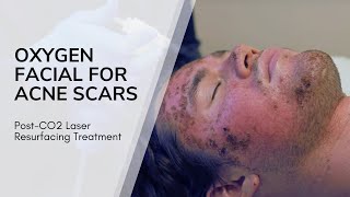 Oxygen Facial For Acne Scars Post-CO2 Laser Resurfacing Treatment  | Live