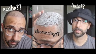 How to wash your hair and remove scabs after a hair transplant / When can you wear hats?