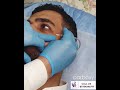تقنيه الكاربوكسي لعلاج الهالات السوداء تحت العين